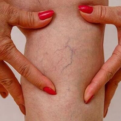 علاج الأوردة العنكبوتية في دبي وأبو ظبي والشارقة والعين