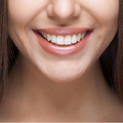 Hydrogen-Peroxide-Whitening-1-1