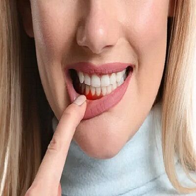 تكلفة علاج نزيف اللثة في دبي
