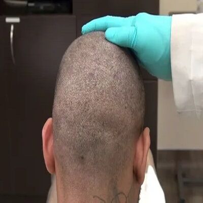 تكلفة زراعة الشعر بدون سكار في دبي